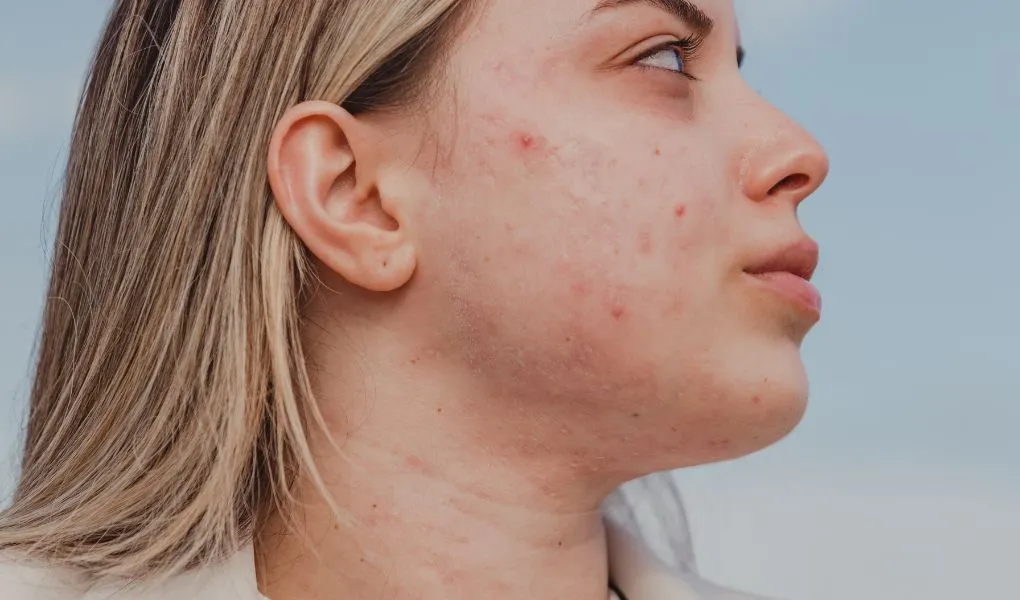 acné