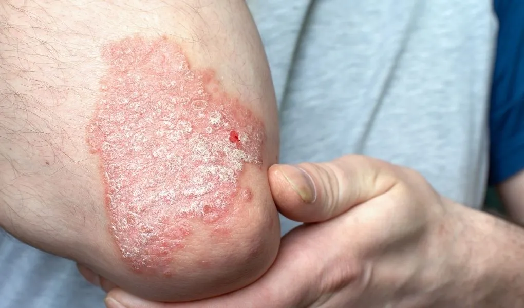 psoriasis