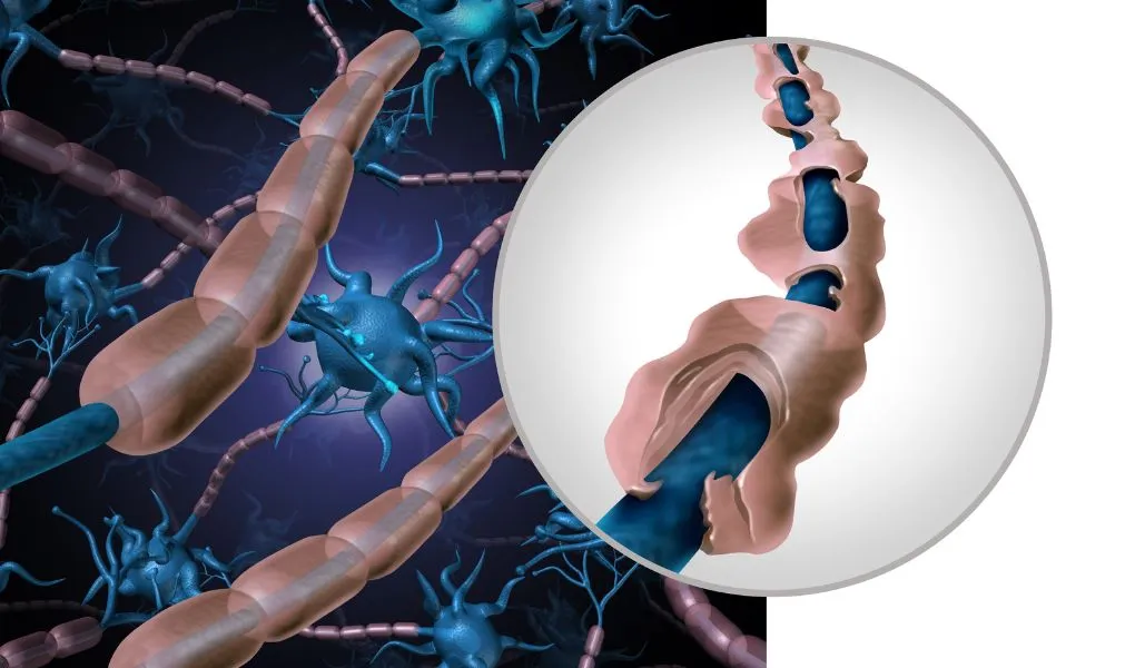 sclérose-en-plaques